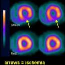 So sánh giá trị của xạ hình tưới máu cơ tim với Tc99m-Sestamibi với điện tim gắng sức trong chẩn đoán bệnh mạch vành 