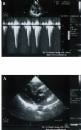Phì đại vách liên thất (A) gây hẹp khít đường ra thất trái (B) với PG=119 mmHg