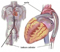 Đặt bóng đối xung động mạch chủ