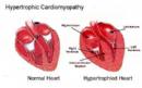 Bệnh cơ tim phì đại