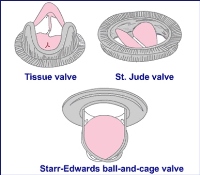 Các thông số siêu âm Doppler bình thường của tất cả các van nhân tạo hai lá và động mạch chủ