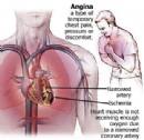 Khuyến cáo điều trị bệnh tim thiếu máu cục bộ mạn tính 