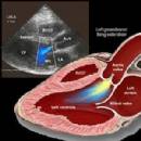 Hở van động mạch chủ