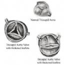 Hẹp van động mạch chủ